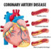 CAD Full Form in Medical