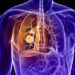 World Lung Cancer Day