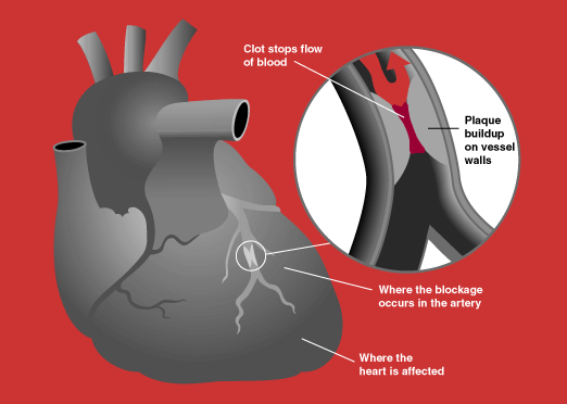 Acute Coronary Syndrome